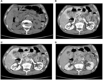 Gallbladder cancer masquerading as xanthogranulomatous cholecystitis: a case report and literature review